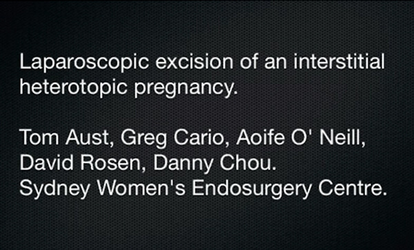 video-Laparoscopic Heterotopic Interstitial Pregnancy